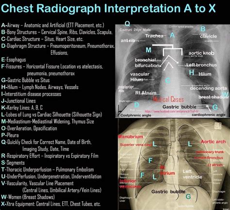 how to cheat chest x ray results